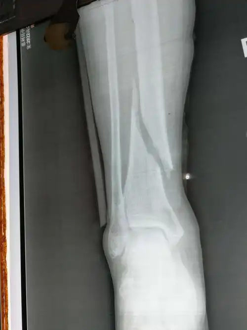 胫骨远端骨折,张力性水泡,皮肤情况欠佳.