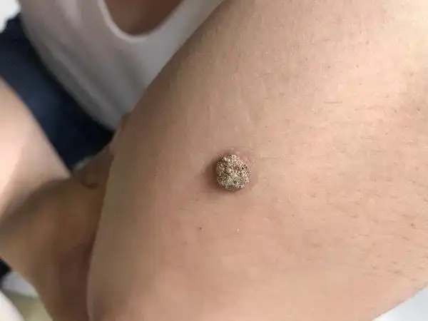 胳膊上长的这个是什么疙瘩