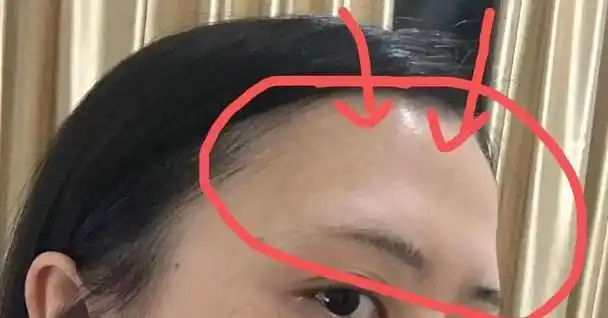 丰额头玻尿酸会下降吗?丰额头注射玻尿酸持续时间是多久?