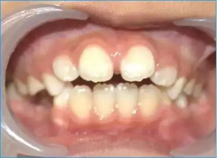 孩子吃手指危害大吗?_牙颌畸形_牙颌畸形发病原因 - 好大夫在线