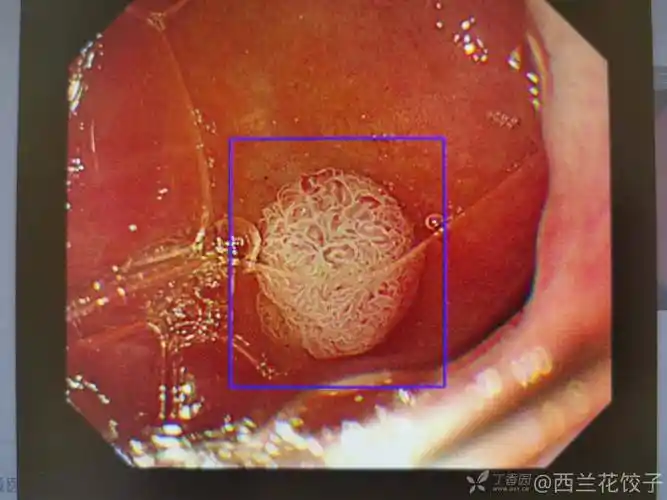 十二指肠球部这个是腺瘤吗