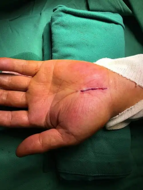 今天完成1例腕管综合征减压术