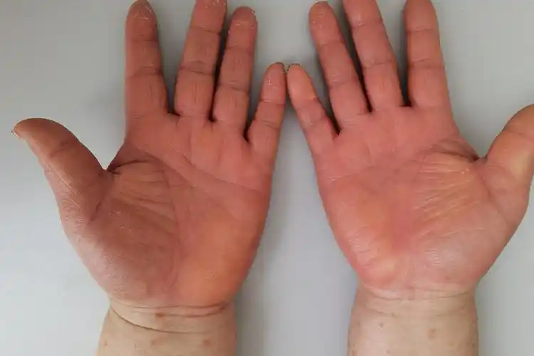 掌跖角化过度图