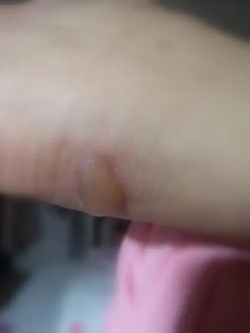 归家后拍出的脚跟水泡,特别记录留念!