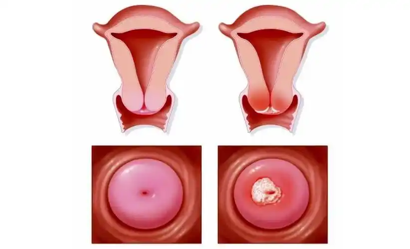 宫颈菜花状是什么病
