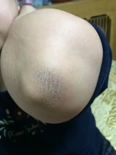 胳膊肘上皮肤异常见照片,没什么疼痒感觉,只是很粗糙.