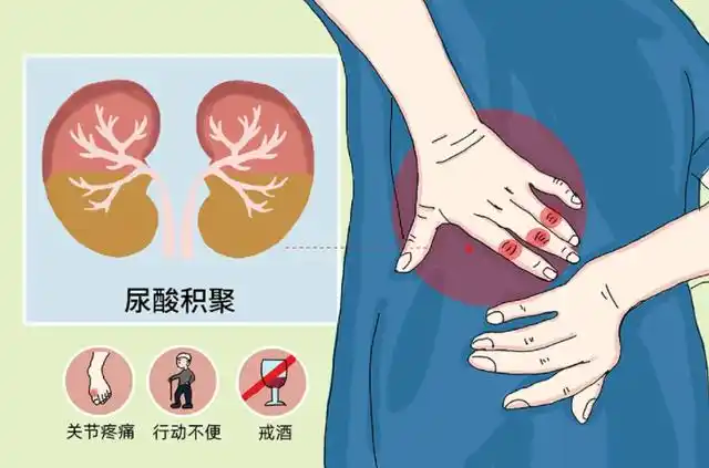 苦瓜可以降尿酸?医生:这5物才是降酸"高手",常吃,预防痛风