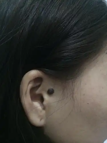 问:痦子长在右耳朵这个位置有什么说法?