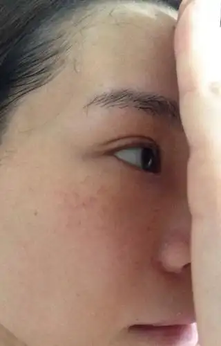 我想知道颧骨上这种叫什么斑,有什么办法可以治愈?多年了.