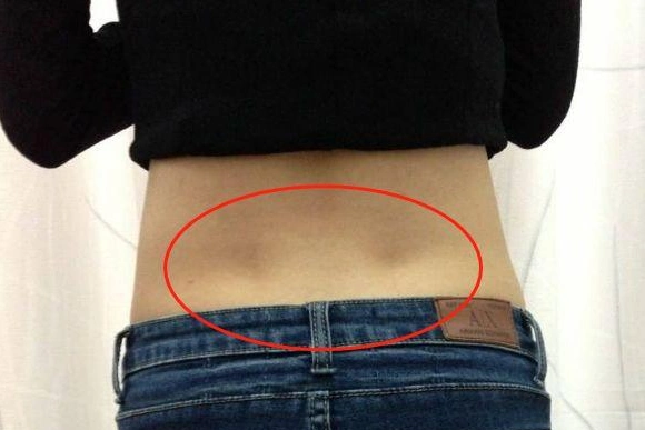 腰窝——"维纳斯的酒窝",为何医学上却称它"先天性缺陷"呢?