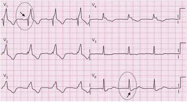 左右束支传导阻滞详解