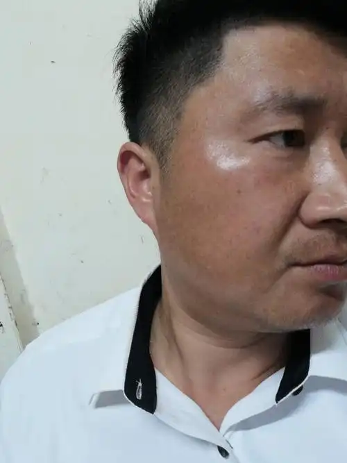 面部皮肤变的发黑,周边的皮肤没有任何异样,有没有