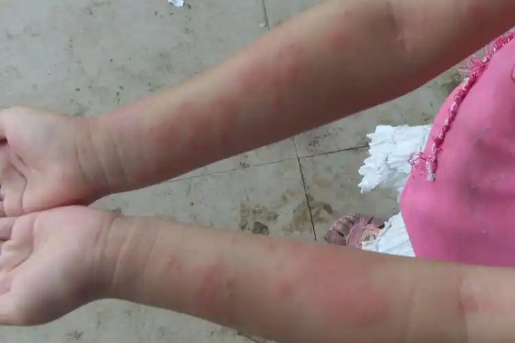 吃桃子过敏的症状