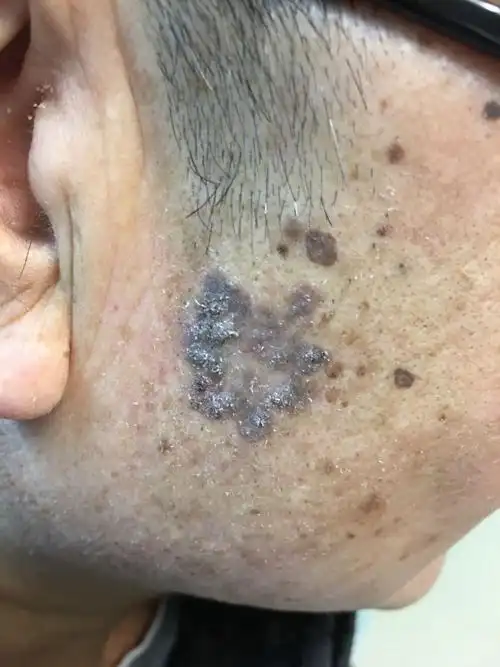 脸上的老年斑能不能癌变?