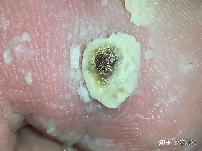 完全真实的跖疣好转过程,花费不到一百元! - 知乎