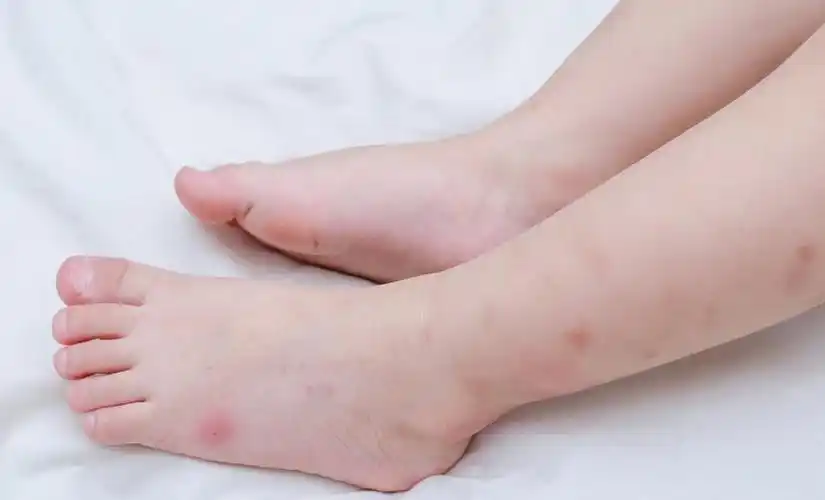 一旦被蚊子叮,抵抗力弱的宝宝很容易诱发感染