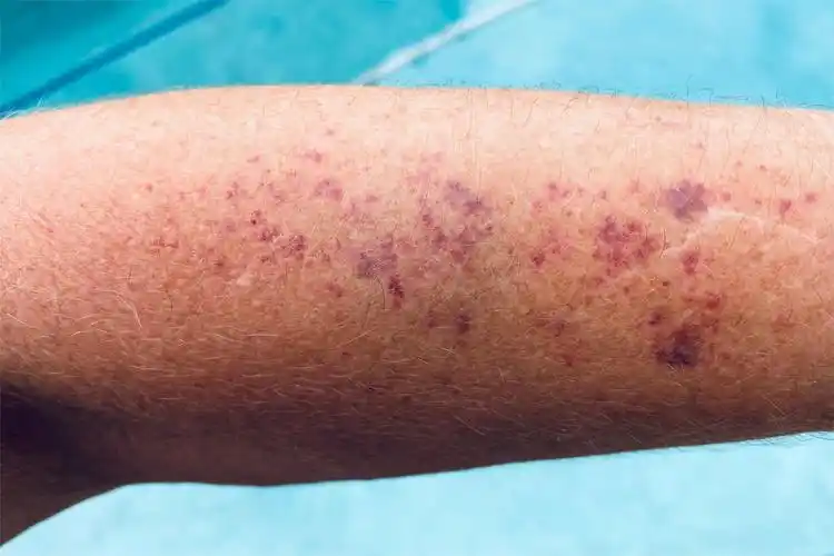 血脂高皮肤斑块图片