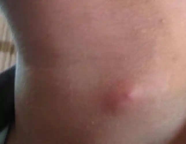 脖子淋巴瘤早期图片_有来医生