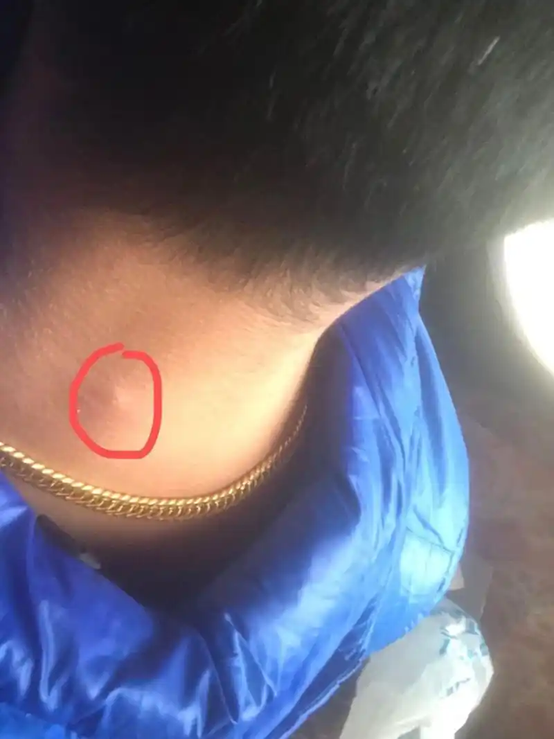 皮脂腺囊肿发炎了 先消炎,看来年后这一刀躲不掉了