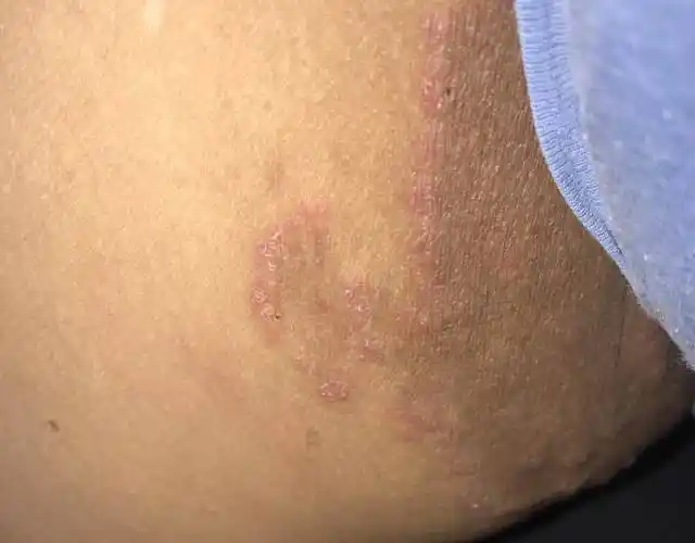 大腿根皮肤又红又痒确诊是真菌感染的股癣用药后却严重了