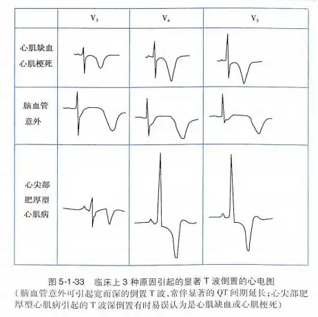 心肌缺血的表现及缓解控制