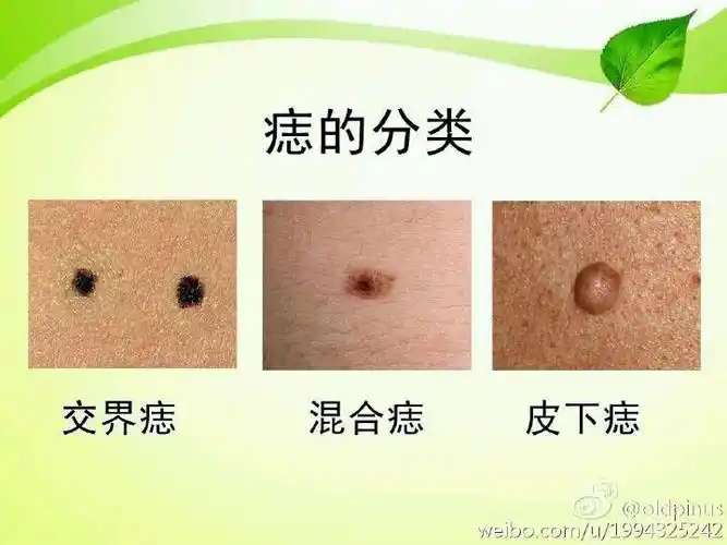 色素痣和健康 - 春雨医生