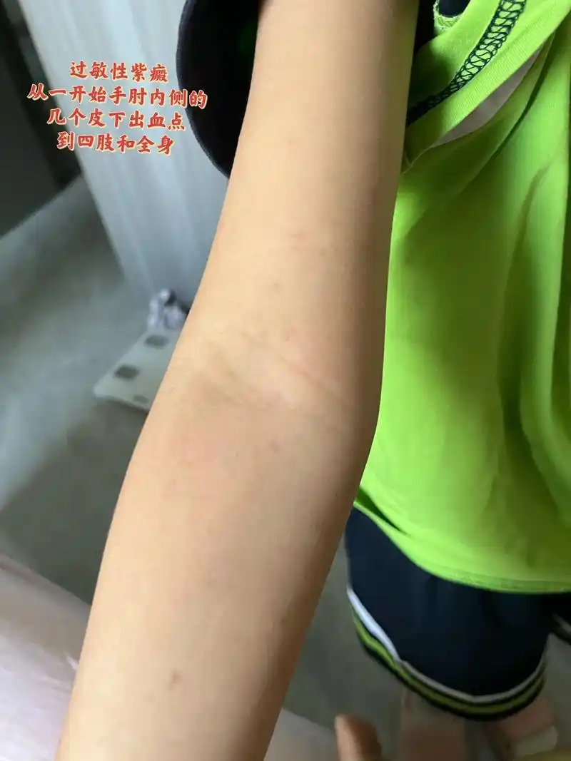 过敏性紫癜.#过敏性紫癜 希望有类似经历的朋友分享一下治疗和 - 抖音