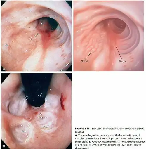 重度反流性食管炎愈合后的表现