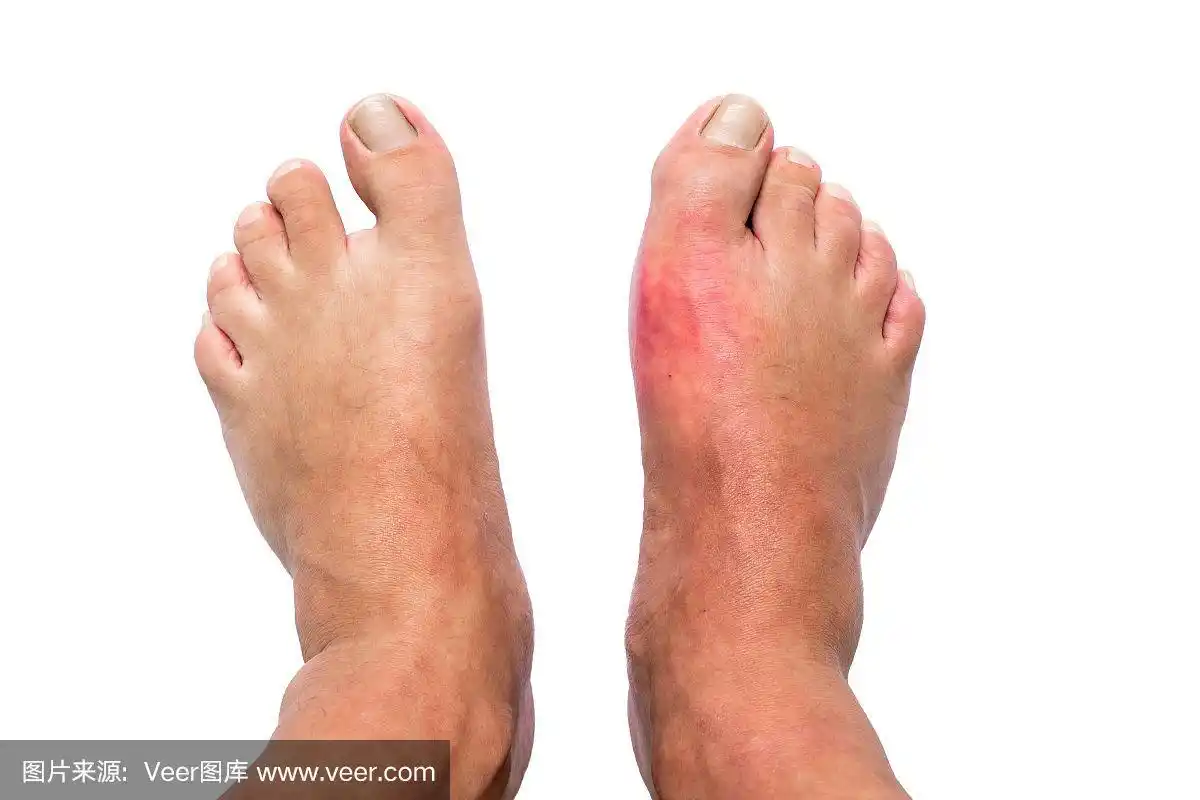 男子右脚肿胀和痛风痛炎症孤立在白色背景