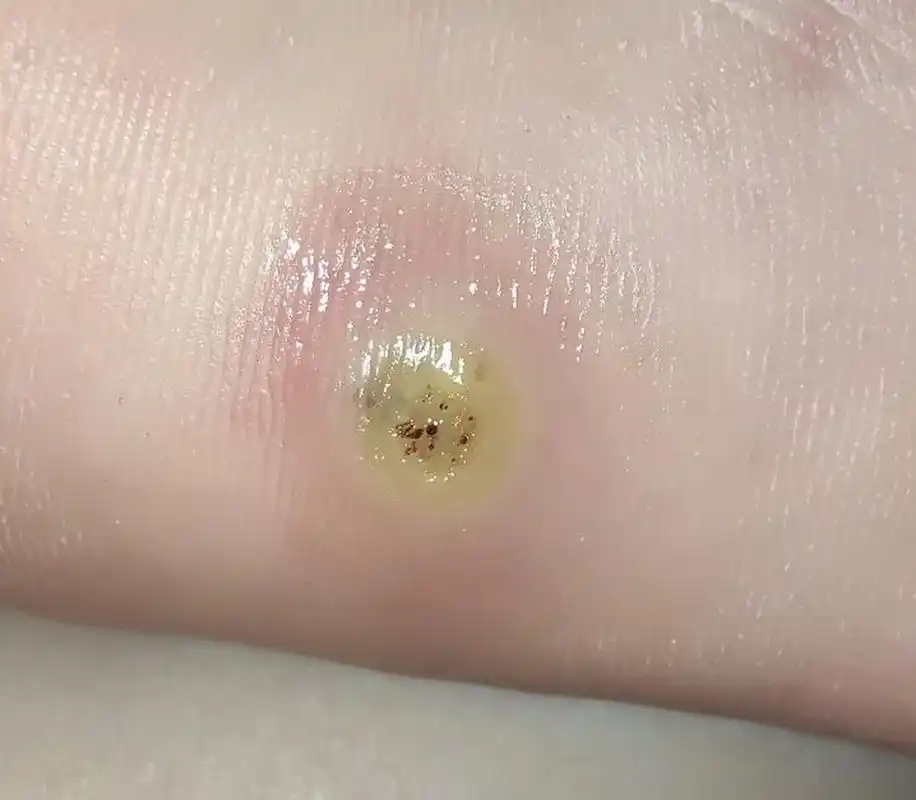 跖疣可以自愈吗?