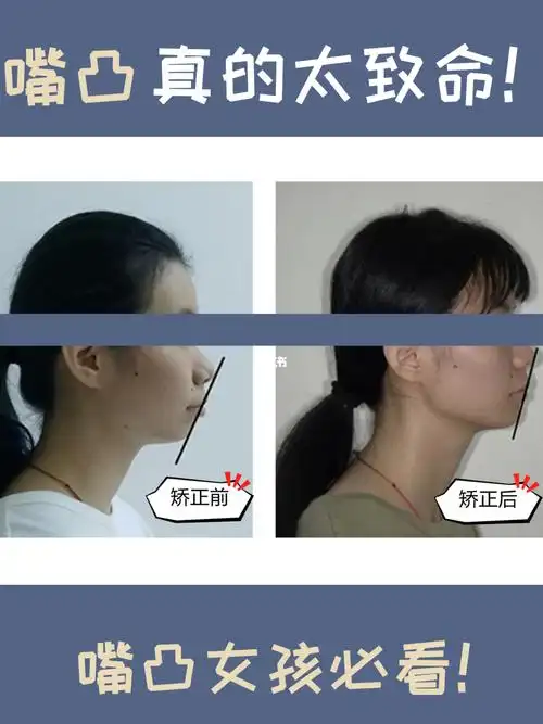 嘴突矫正案例99