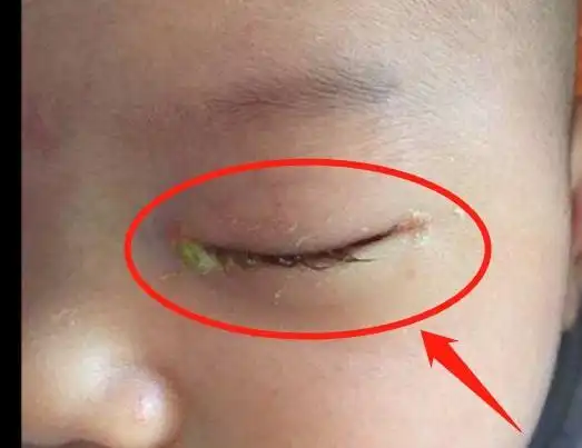 干干净净的,突然某天眼屎增多,这即使肠胃不好的征兆,也是孩子上火了