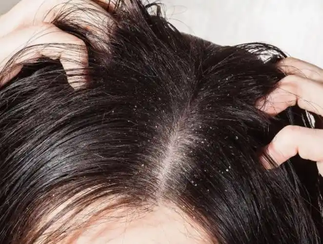头皮屑是如何产生的 - 病症知识 - 轻壹
