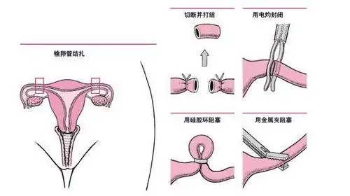 结了扎好后悔,我现在又结婚了,想要一个小孩都不能了,女人就是命苦啊