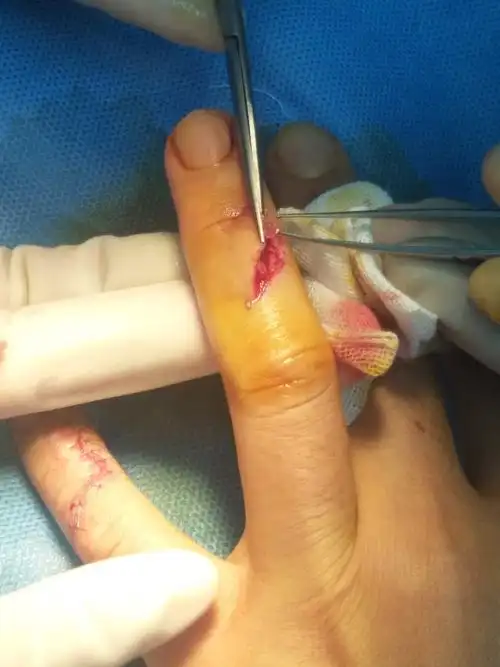 皮肤科新开展外伤美容缝合技术