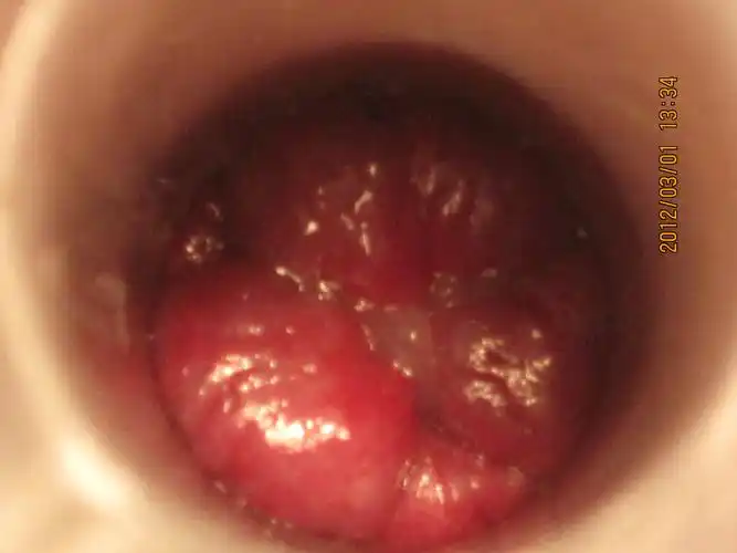 第二十六例环状静脉曲张混合痔陈术前术中术后图 - 肛肠外科讨论版