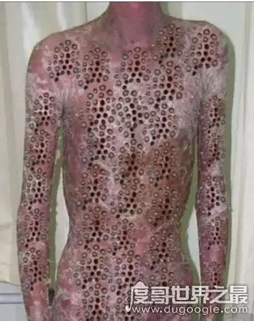 bing,在非洲等环境卫生很差的湿热地区有一种名为"嗜人瘤蝇幼虫"虫子