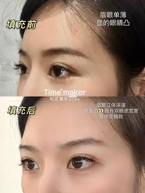 神仙心机部位眉弓填充