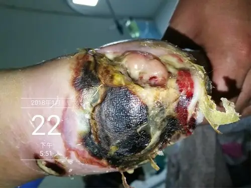 入院时左侧足跟可见明显皮肤溃烂面,局部可见黑痂,筋膜外露