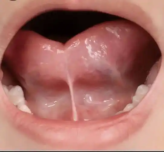 根据舌系带牵制舌尖时的形状,将舌系带过短分为正常,弧形,凹形,楔形;1