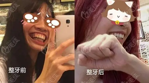 成年后骨性凸嘴当然可以改善了,不信你来看我矫正前后的图片对比