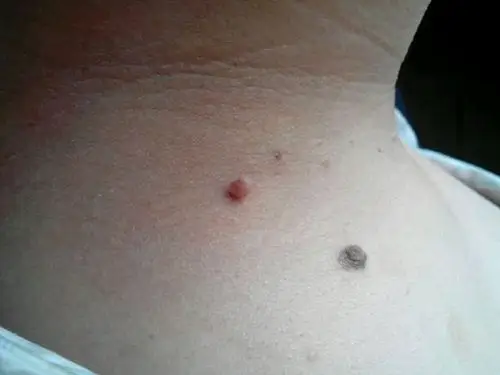 颈部皮肤疣如何治疗