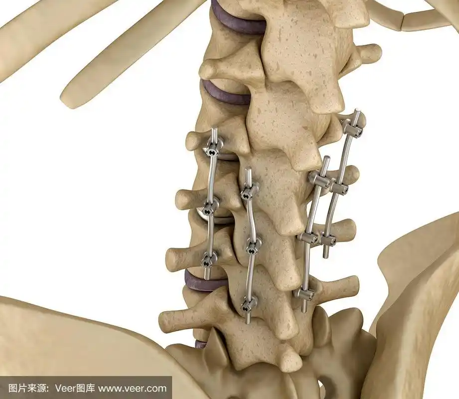 脊柱固定系统-钛支架.