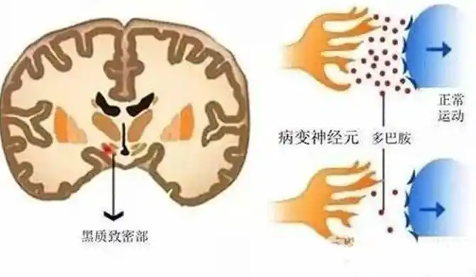 手术治疗帕金森病由哪些因素决定?