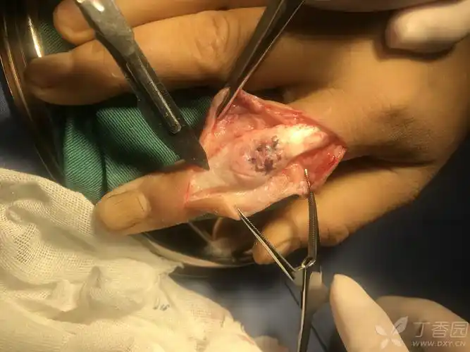 一例陈旧性纽扣指畸形