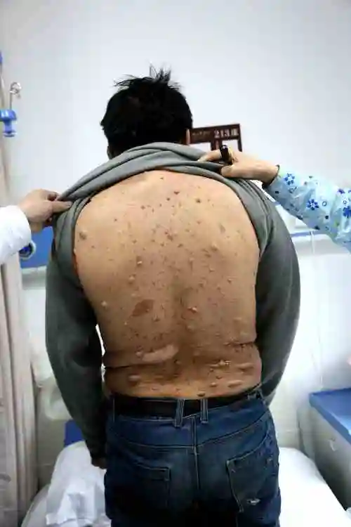 37岁土家汉子全身长满密密麻麻的肉疙瘩