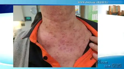 主题讲堂刘涛医生肺癌靶向药治疗后皮肤不良反应