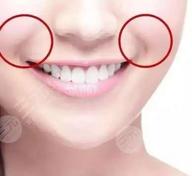 鼻唇沟整形美容超全科普!术前术后注意事项贴心分享