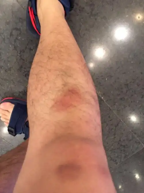 小腿右侧胫骨 红色的 按压有痛感 像被撞了一样 请问这是怎么了