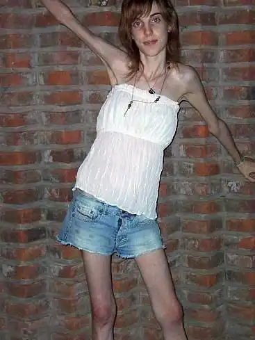 皮包骨纸片人!瘦到惊人的厌食症患者